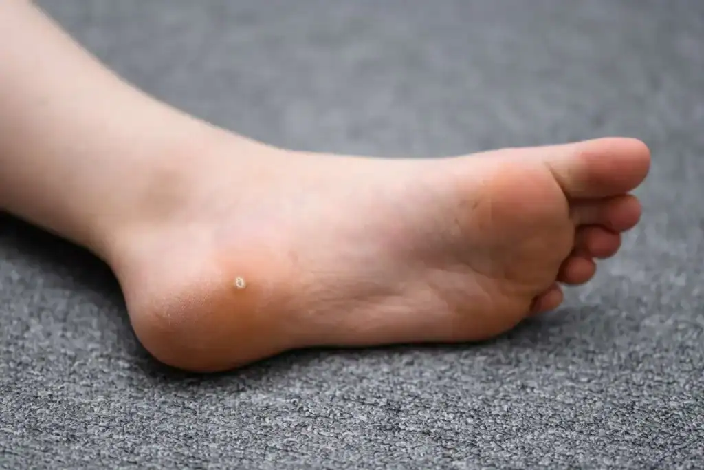 Cryotherapy For Warts And Also Verrucas 2 Image of verruca on the bottom of the foot that able to be treated with Cryotherapy Windsor