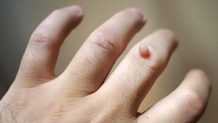 Cryotherapy For Warts And Also Verrucas 1 Image of blemish that Cryotherapy Windsor can remove with Lipo 360.