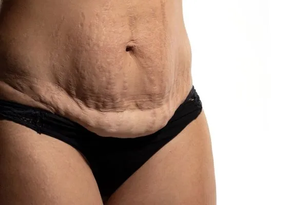 The Science of Skin Tightening 1 The science behind skin tightening Windsor picture of a woman's sagging skin on the stomach